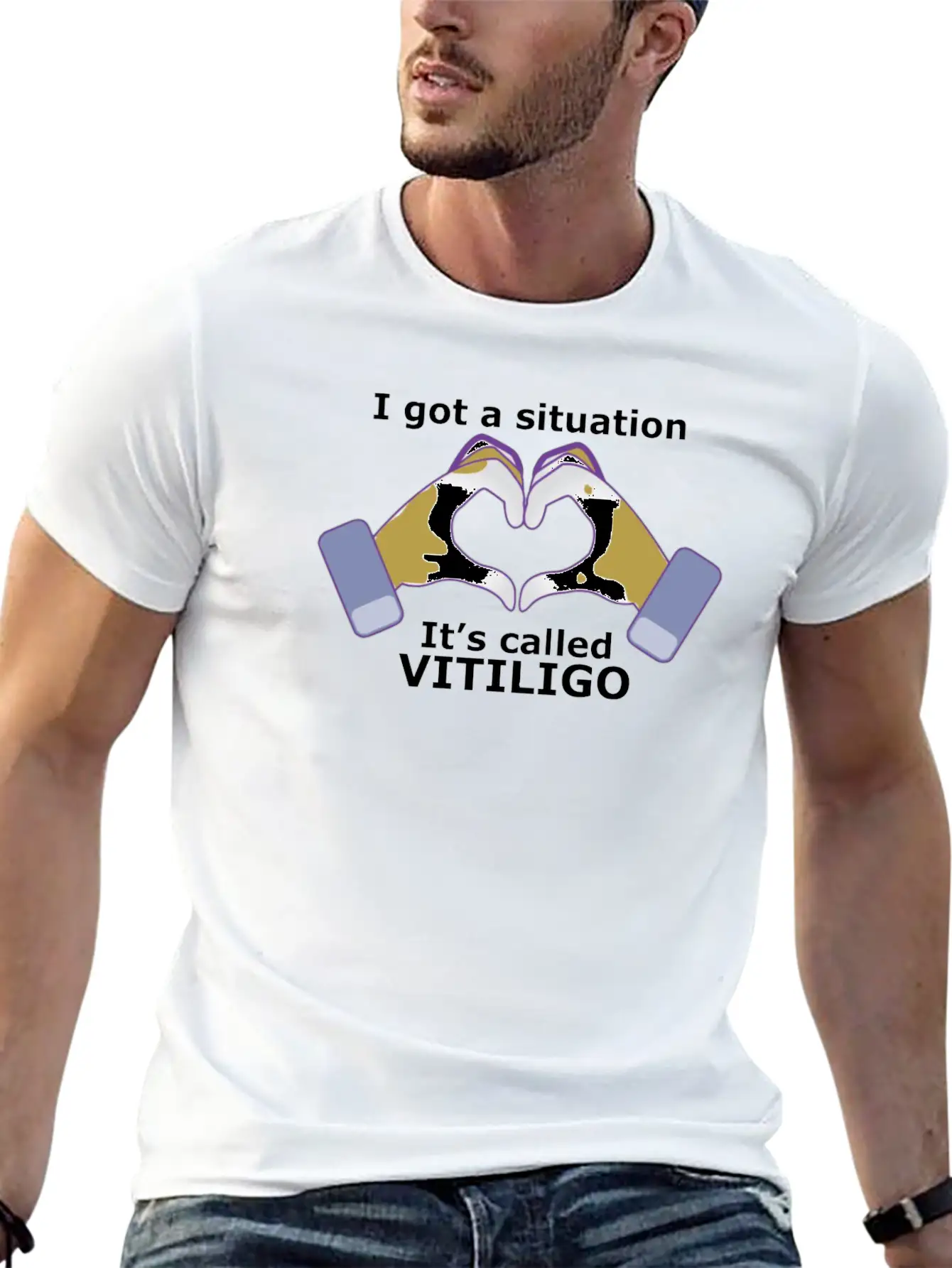 I Got A Situation, It's Called VITILIGO Stylish Everyday T-Shirt – Unisex Basic Cotton Tee